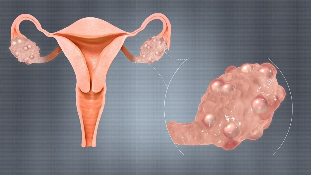 PCOS-TREATMENT